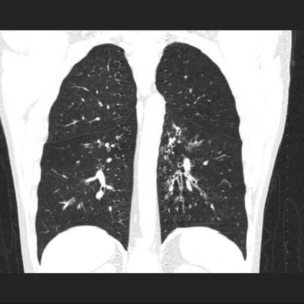 File:Allergic bronchopulmonary aspergillosis (Radiopaedia 21386-21320 Coronal lung window 12).jpg