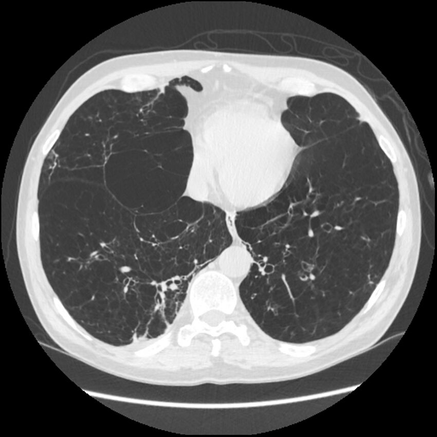 Alpha-1-antitrypsin deficiency (Radiopaedia 40993-43722 Axial lung window 177).jpg
