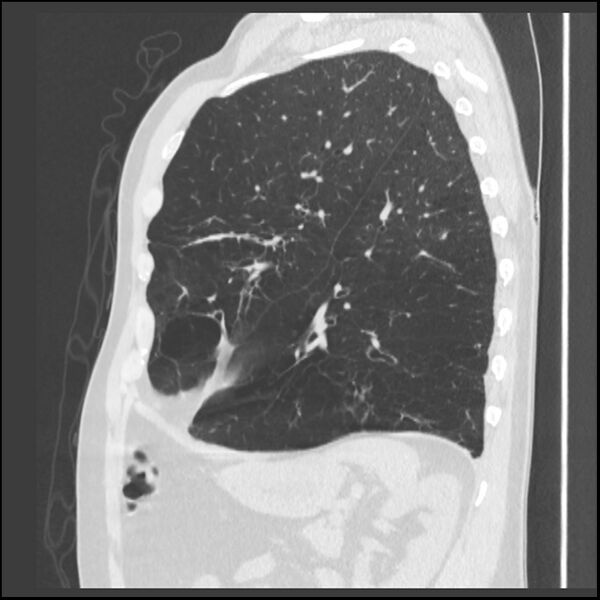File:Alpha-1-antitrypsin deficiency (Radiopaedia 40993-43722 Sagittal lung window 77).jpg