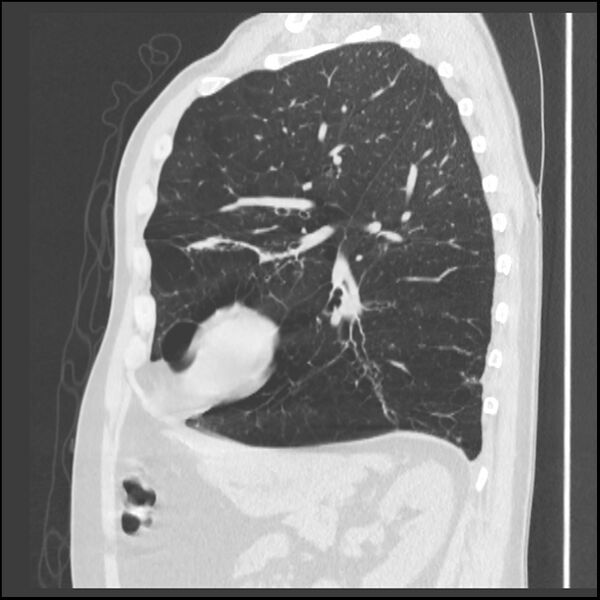 File:Alpha-1-antitrypsin deficiency (Radiopaedia 40993-43722 Sagittal lung window 87).jpg