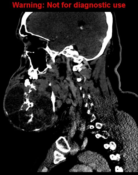 File:Ameloblastoma (Radiopaedia 33126-34164 F 28).jpg
