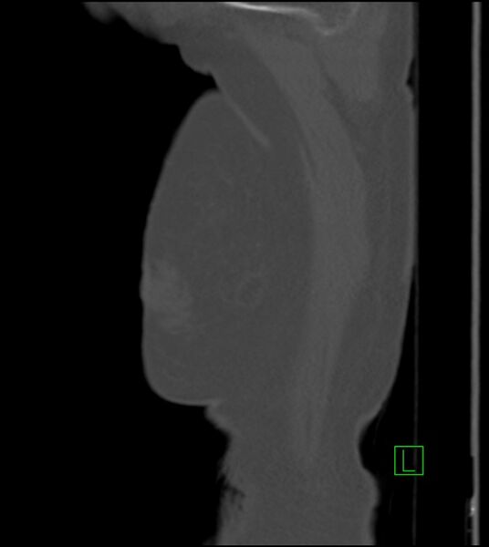 File:Amiodarone deposition in the liver (Radiopaedia 77587-89780 Sagittal bone window 96).jpg