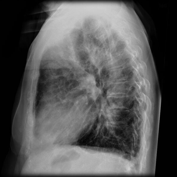 File:Amiodarone lung (Radiopaedia 6539-7850 Lateral 1).jpg
