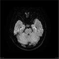 Amnestic syndrome secondary to hypoxic brain injury (Radiopaedia 24743-25004 DWI 11).jpg