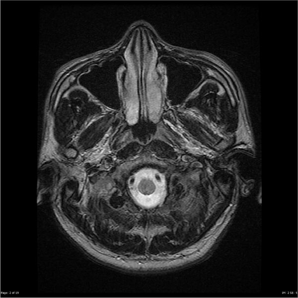 File:Amnestic syndrome secondary to hypoxic brain injury (Radiopaedia 24743-25004 T2 2).jpg