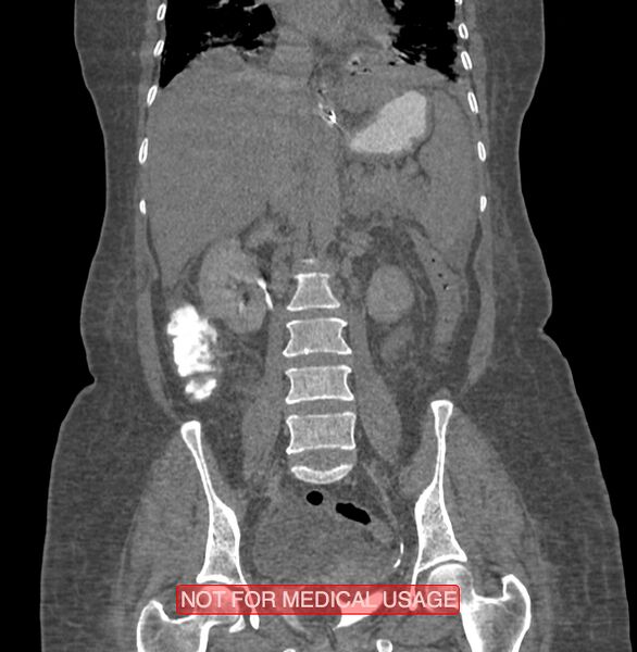 File:Amoebic enterocolitis with liver abscess (Radiopaedia 35100-36609 B 119).jpg
