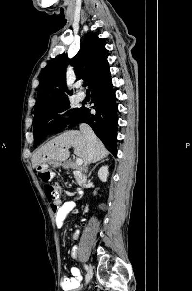 File:Ampullary adenocarcinoma (Radiopaedia 86093-102033 E 34).jpg