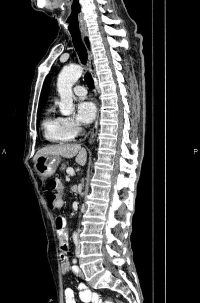 File:Ampullary adenocarcinoma (Radiopaedia 86093-102033 E 46).jpg