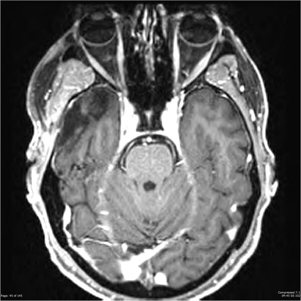 File:Anaplastic meningioma with recurrence (Radiopaedia 34452-35788 Axial T1 C+ 45).jpg