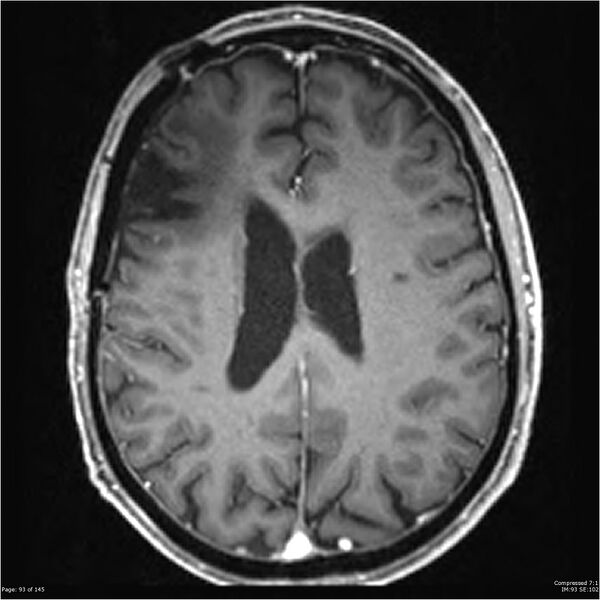 File:Anaplastic meningioma with recurrence (Radiopaedia 34452-35788 Axial T1 C+ 93).jpg