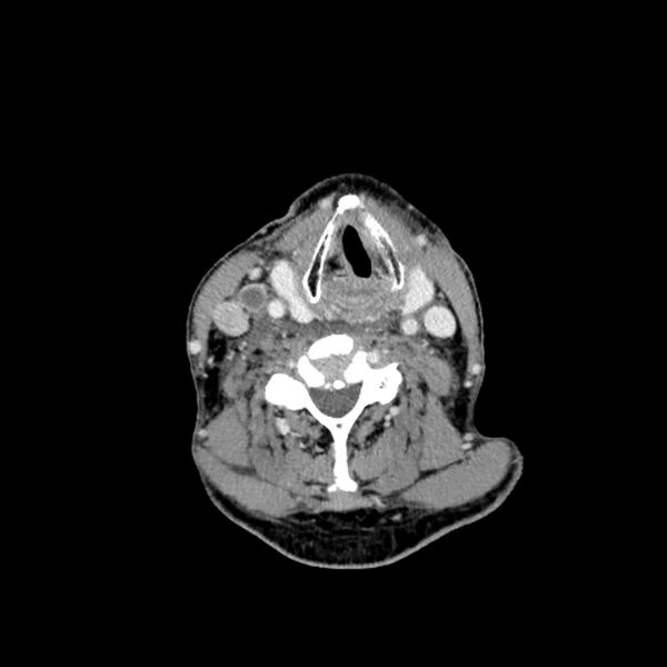 File:Anaplastic thyroid carcinoma (Radiopaedia 79087-92034 B 59).jpg