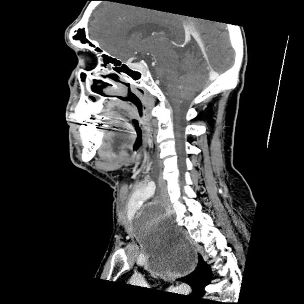 File:Anaplastic thyroid carcinoma (Radiopaedia 79087-92034 C 42).jpg
