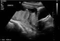 Anencephaly in a monochorionic monoamniotic twin pregnancy (Radiopaedia 68827).jpg