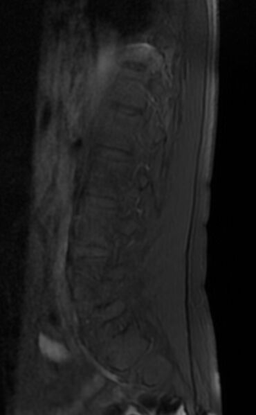 File:Ankylosing spondylitis - Andersson lesion (Radiopaedia 81878-95838 Sagittal T1 fat sat 3).jpg