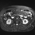 Annular pancreas (Radiopaedia 38292-40320 Axial T2 fat sat 22).png