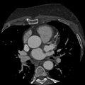 Anomalous origin of left circumflex artery from right coronary sinus (Radiopaedia 72563-83117 B 32).jpg