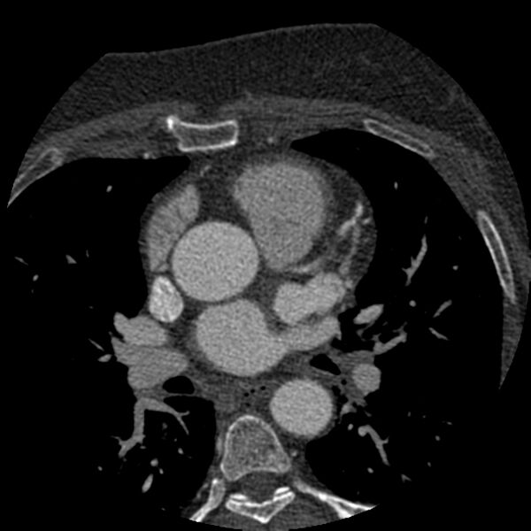 File:Anomalous origin of left circumflex artery from right coronary sinus (Radiopaedia 72563-83117 B 32).jpg