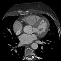 Anomalous origin of left circumflex artery from right coronary sinus (Radiopaedia 72563-83117 B 65).jpg