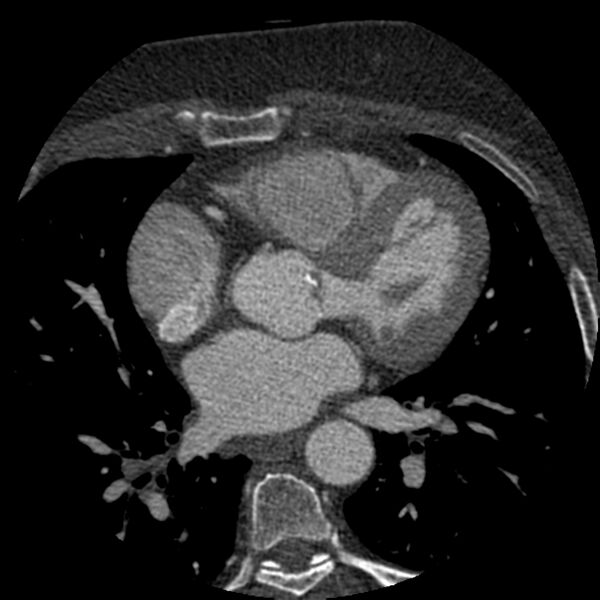 File:Anomalous origin of left circumflex artery from right coronary sinus (Radiopaedia 72563-83117 B 65).jpg
