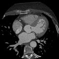 Anomalous origin of left circumflex artery from right coronary sinus (Radiopaedia 72563-83117 B 70).jpg