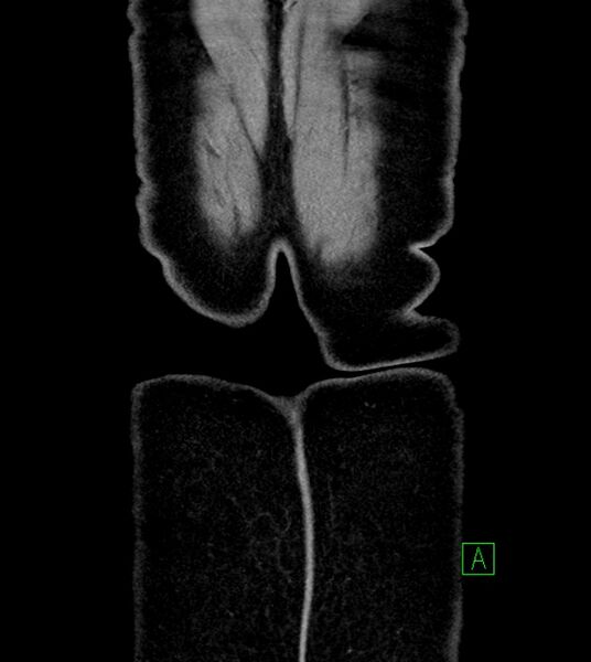 File:Anterior abdominal wall CSF pseudocyst (CSFoma) (Radiopaedia 79453-92571 B 55).jpg