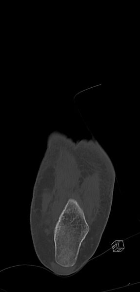 File:Anterior calcaneal process fracture (Radiopaedia 63353-71943 Coronal bone window 40).jpg