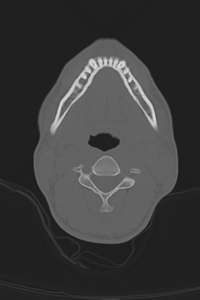 File:Anterior nasal spine fracture (Radiopaedia 46138-50494 Axial bone window 71).png