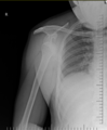 Anterior shoulder dislocation (Radiopaedia 26999).png