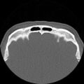 Antrochoanal polyp (Radiopaedia 15098-14982 Axial non-contrast 33).jpg