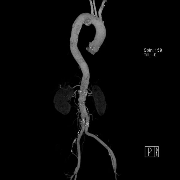 File:Aortic arch saccular aneurysm (Radiopaedia 19430-19457 A 11).jpg