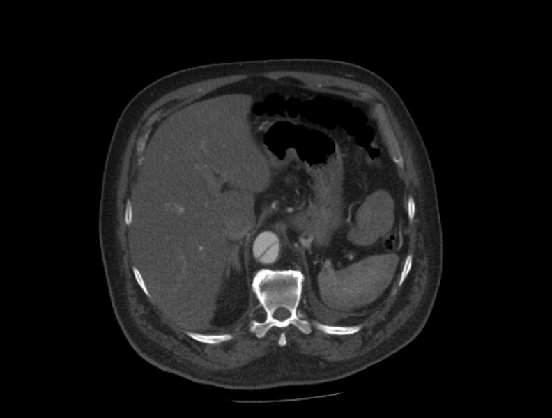 File:Aortic dissection (Radiopaedia 28802-29105 A 41).jpg