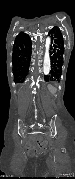File:Aortic dissection with extension into aortic arch branches (Radiopaedia 64402-73204 A 65).jpg