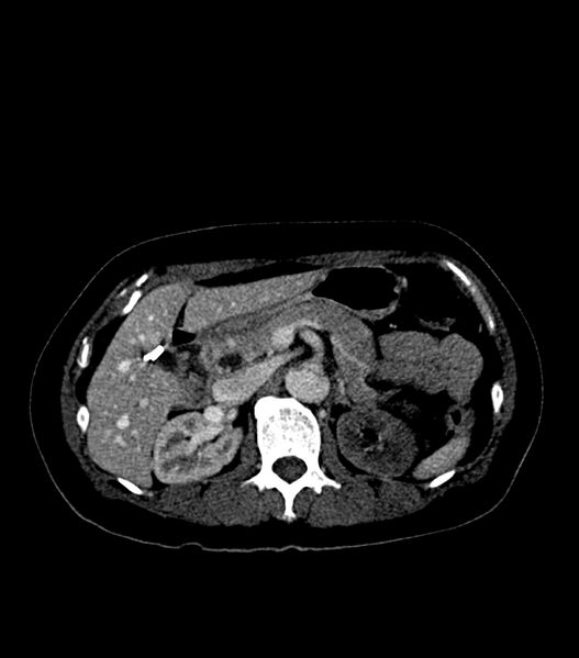 File:Aortic dissection with renal ischemia (Radiopaedia 76573-88338 B 31).jpg