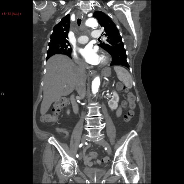 File:Aortic intramural hematoma (Radiopaedia 27746-28001 B 29).jpg