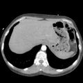 Aortic valve non-coronary cusp thrombus (Radiopaedia 55661-62189 B 45).png