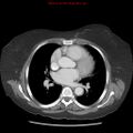 Aortic valve stenosis (Radiopaedia 14480-14423 C 3).jpg