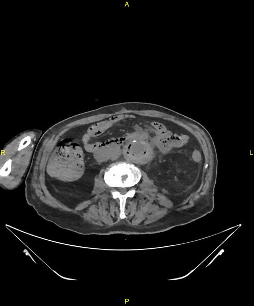 File:Aortoenteric fistula (Radiopaedia 84308-99603 Axial non-contrast 188).jpg