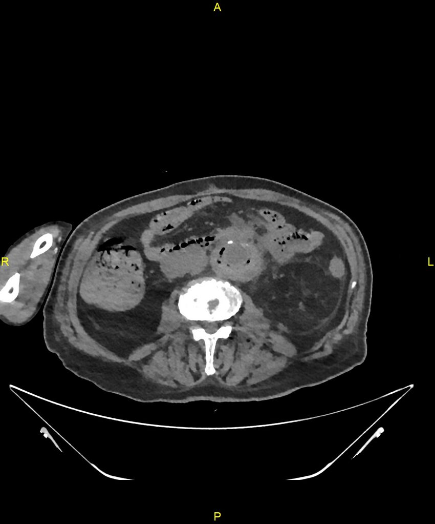 Aortoenteric fistula (Radiopaedia 84308-99603 Axial non-contrast 188).jpg