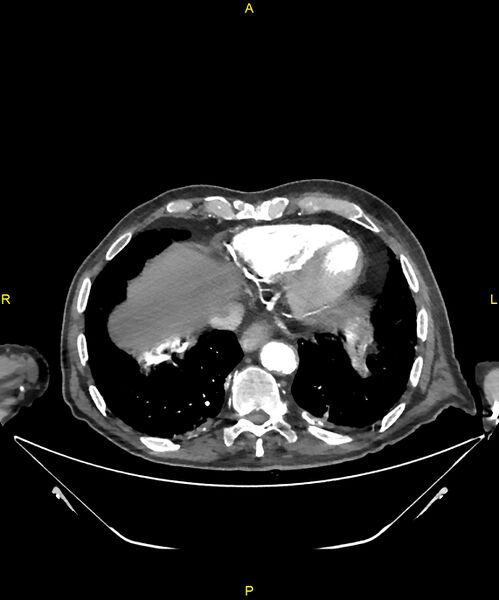 File:Aortoenteric fistula (Radiopaedia 84308-99603 B 12).jpg