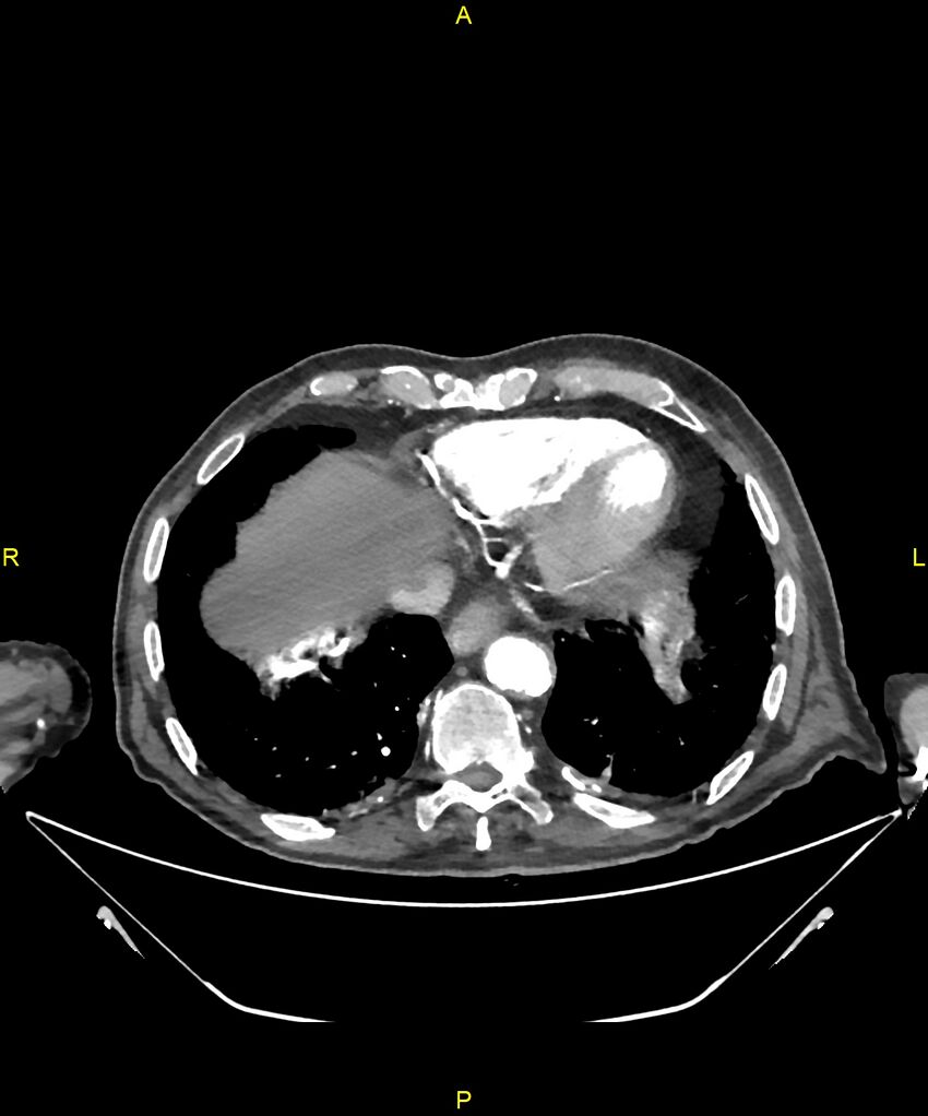 Aortoenteric fistula (Radiopaedia 84308-99603 B 12).jpg