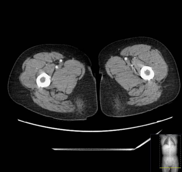 File:Appendicitis (CT angiogram) (Radiopaedia 154713-127660 Axial 136).jpg