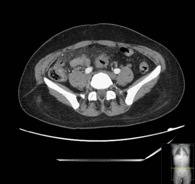 File:Appendicitis (CT angiogram) (Radiopaedia 154713-127660 Axial 25).jpg