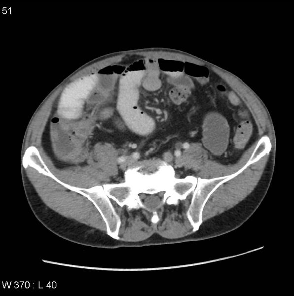 File:Appendicitis (Radiopaedia 27446-27642 A 30).jpg