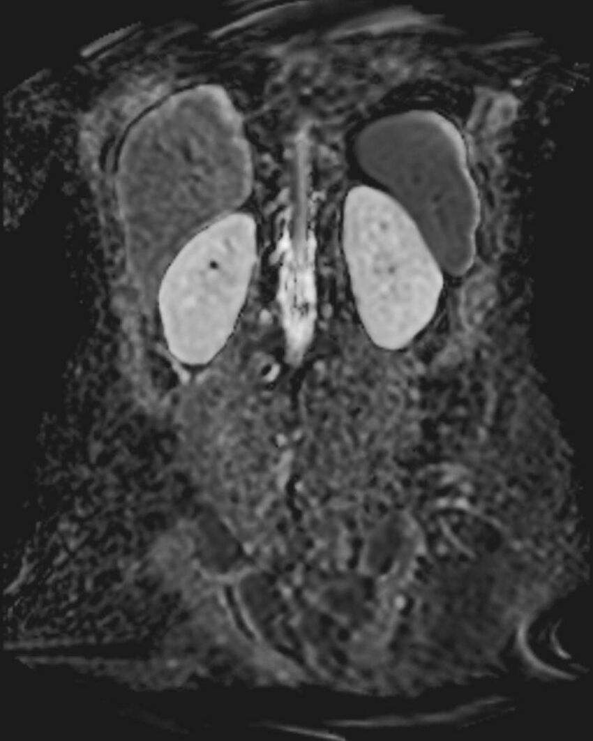 Appendicitis in gravida (MRI) (Radiopaedia 89433-106395 Coronal ADC 45).jpg