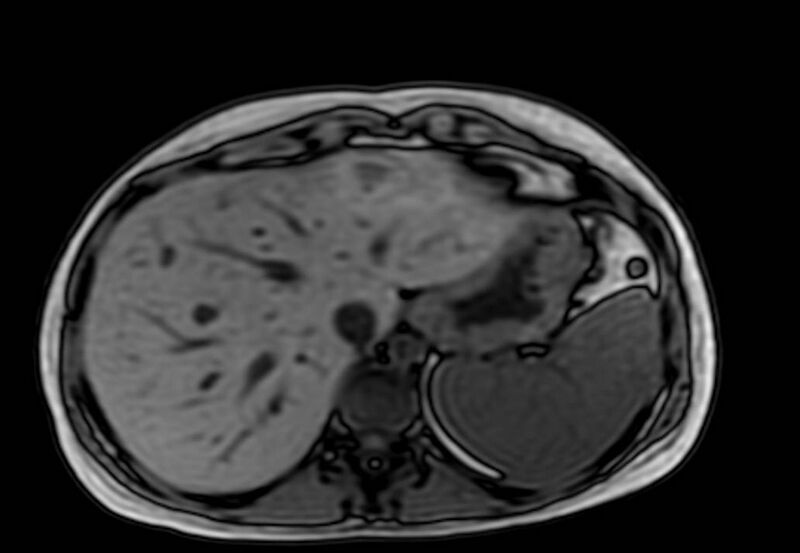 File:Appendicitis in gravida (MRI) (Radiopaedia 89433-106395 D 7).jpg