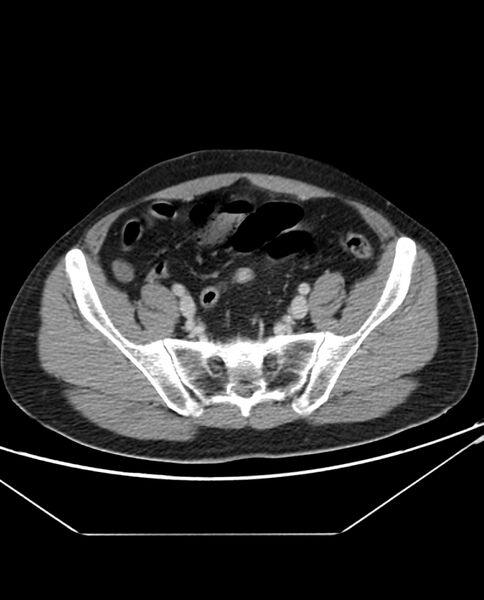 File:Arterial occlusive mesenteric ischemia (Radiopaedia 84641-100054 A 94).jpg