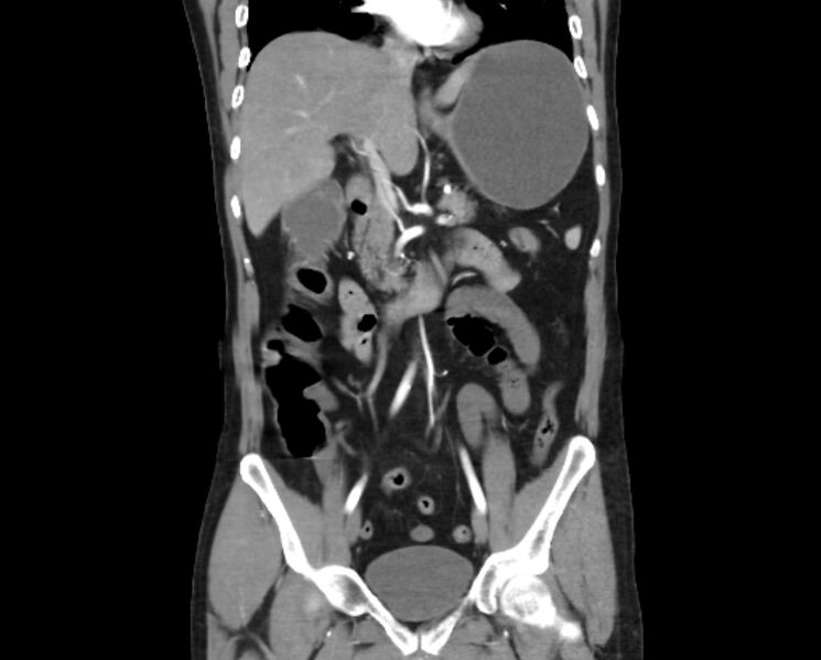 File:Arterial occlusive mesenteric ischemia (Radiopaedia 84641-100060 B 27).jpg