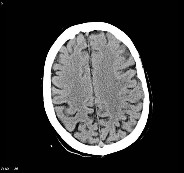 File:Arteriovenous malformation - cerebral (Radiopaedia 8172-9020 Axial non-contrast 17).jpg