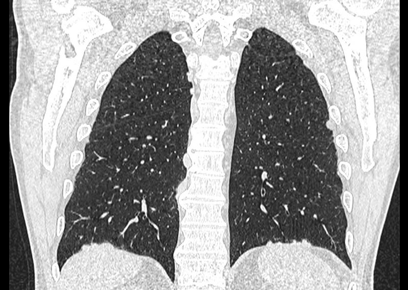 File:Asbestos pleural placques (Radiopaedia 57905-64872 Coronal lung window 221).jpg