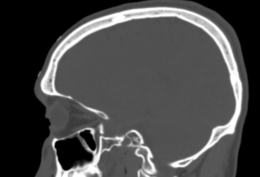 Asymptomatic occipital spur (Radiopaedia 87753-104201 Sagittal bone window 195).jpg